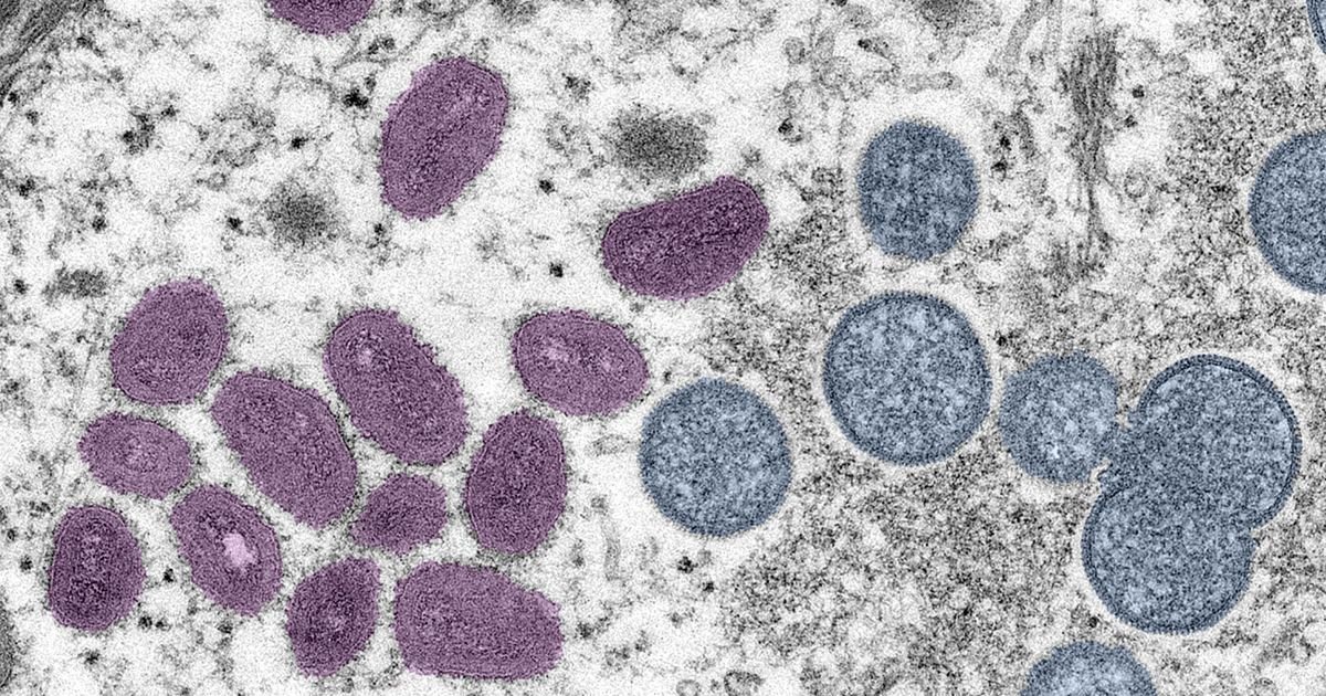 Caso de Mpox é confirmado em Porto Alegre