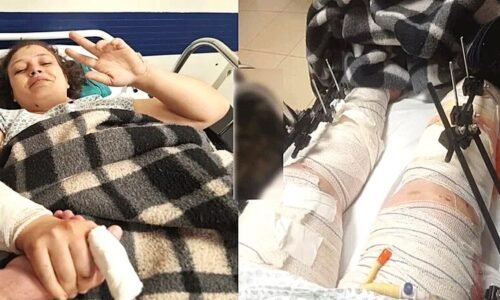Jovem mãe ferida em acidente com viatura da PM precisa de ajuda para tratamento