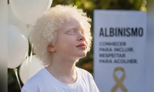 Dia Internacional de Conscientização sobre o Albinismo combate preconceitos e promove inclusão