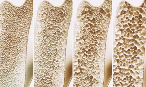 Millions take calcium and vitamin D for stronger bones. A major review finds little benefit
