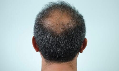 Alopecia androgenética afeta milhões de pessoas e continua sendo a principal causa de queda de cabelo em homens e mulheres