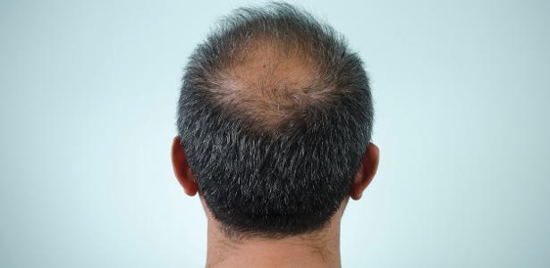 Alopecia androgenética afeta milhões de pessoas e continua sendo a principal causa de queda de cabelo em homens e mulheres