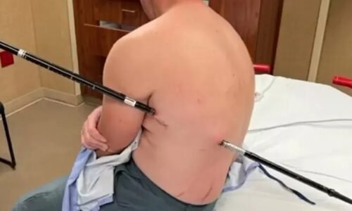 Enfermeiro sobrevive após cair sobre bastão de caminhada que atravessou suas costas