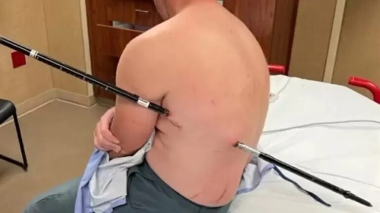 Enfermeiro sobrevive após cair sobre bastão de caminhada que atravessou suas costas