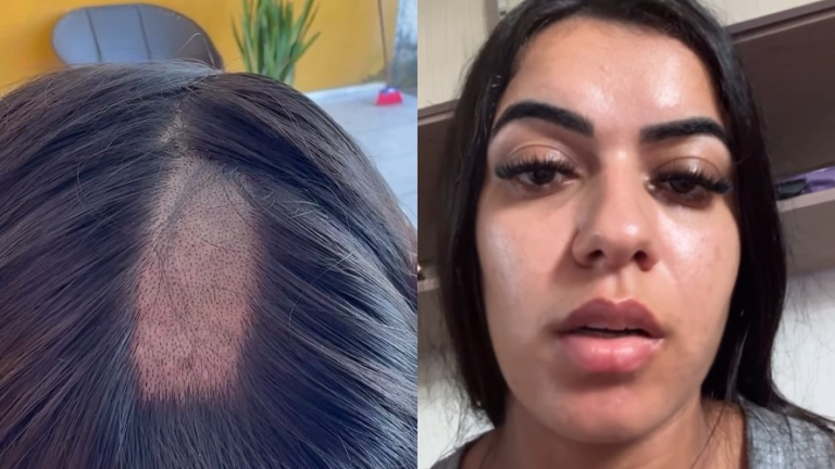 Mulher denuncia clínica após ter cabelo raspado em exame toxicológico para CNH